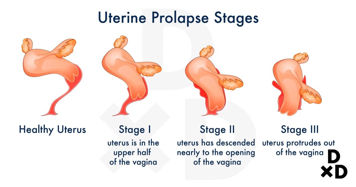 Uterine Prolapse Results In Signs And Symptoms And Procedure Karasuartworks Com